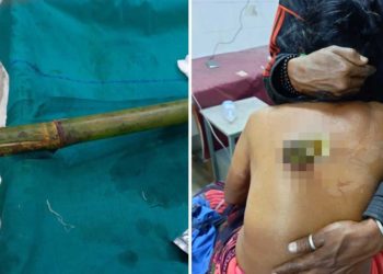 বুকুৰে সোমাই পিঠিৰে ওলাইছিল বাঁহ! চাৰি ঘণ্টাৰ জটিল অস্ত্রোপচাৰত প্ৰাণ বাচিল বৃদ্ধাৰ
