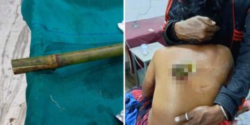বুকুৰে সোমাই পিঠিৰে ওলাইছিল বাঁহ! চাৰি ঘণ্টাৰ জটিল অস্ত্রোপচাৰত প্ৰাণ বাচিল বৃদ্ধাৰ