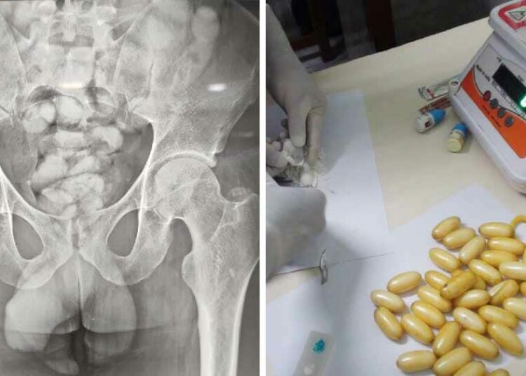 পেটৰ ভিতৰত আধা কিলো কোকেইন! ব্ৰাজিলৰ যুৱকৰ শৰীৰৰ পৰা উদ্ধাৰ ৪৪ টা কেপচুল
