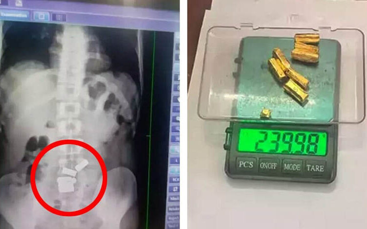 Young man eats gold I সাত টুকুৰা সোণ খাইছিল এজন যুৱকে, অস্ত্ৰোপচাৰ নকৰাকৈ উলিয়ালে চিকিৎসকে 1 Young man eats gold I সাত টুকুৰা সোণ খাইছিল এজন যুৱকে, অস্ত্ৰোপচাৰ নকৰাকৈ উলিয়ালে চিকিৎসকে